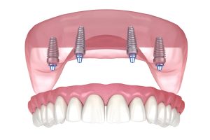 all-on-4 dental implants
