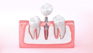 osseointegration of dental implant