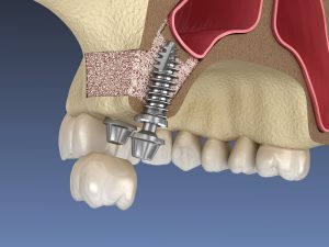 dental implants after a sinus lift