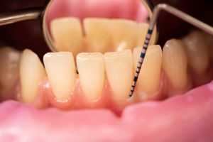 dentist examines periodontal pocket depth
