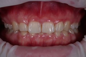closeup of a gummy smile pre-crown lengthening treatment