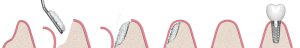 bone grafting to dental implant process
