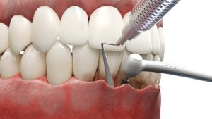 3d render of pocket reduction surgery