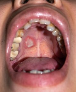oral pathology warning signs