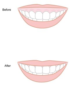 before and after gum contouring