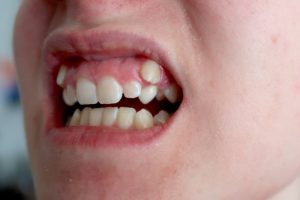 impacted canines
