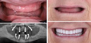 dental implant surgery