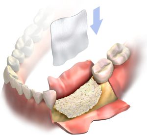 guided tissue regeneration