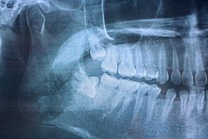 wisdom tooth x-rays
