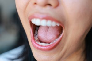 woman opening her mouth to show tooth decay