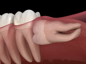 horizontal impaction