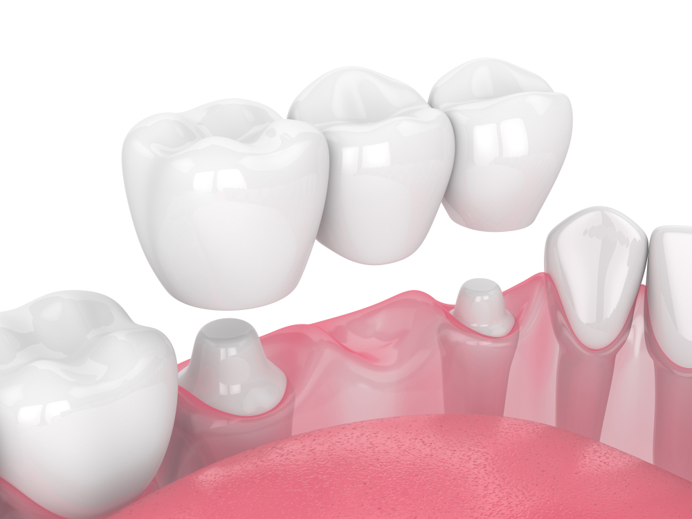 traditional dental bridge supported by prepared teeth