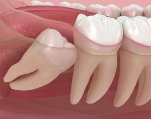 mesial impaction