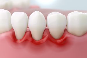 periodontal inflammation indicating gum disease or trauma