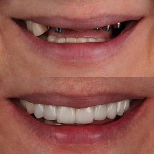 dental implants before and after
